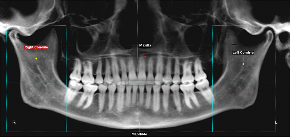 Maxilla Mandible Right Condyle R Left Condyle