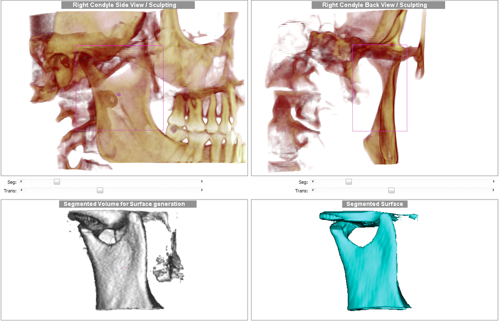 Right Condyle Back View Sculpting Seg: Trans: Segmented Surface Right Condyle Side View / Sculpting Seg: Trans: Segmented Volume for Surface generation