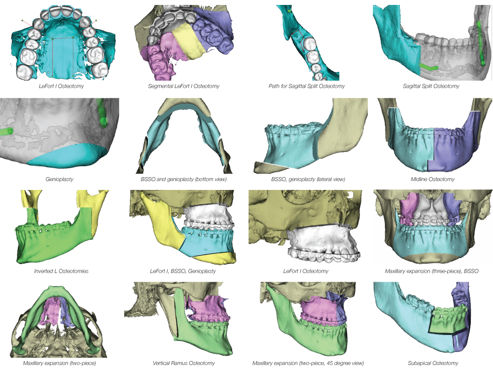 Lefort / Osteotomy Genioplasty Inverted L Osteotomies Maxillary expansion (two-piece) Path for Sagitta Split Osteotomy BSSO, genioplasty (lateral view) Lefort / Osteotomy Maxillary excansion (two-piece, 45 degree view) Sagittal Split Osteotomy Midline Osteotomy Maxillary expansion (three-piece), BSSO Subapical Osteotomy Segmental L6Fort / Osteotomy 8SSO and genioplasty (bottom view) LeFort I, BSSO, Genioplasty Vertical Ramus Osteotomy